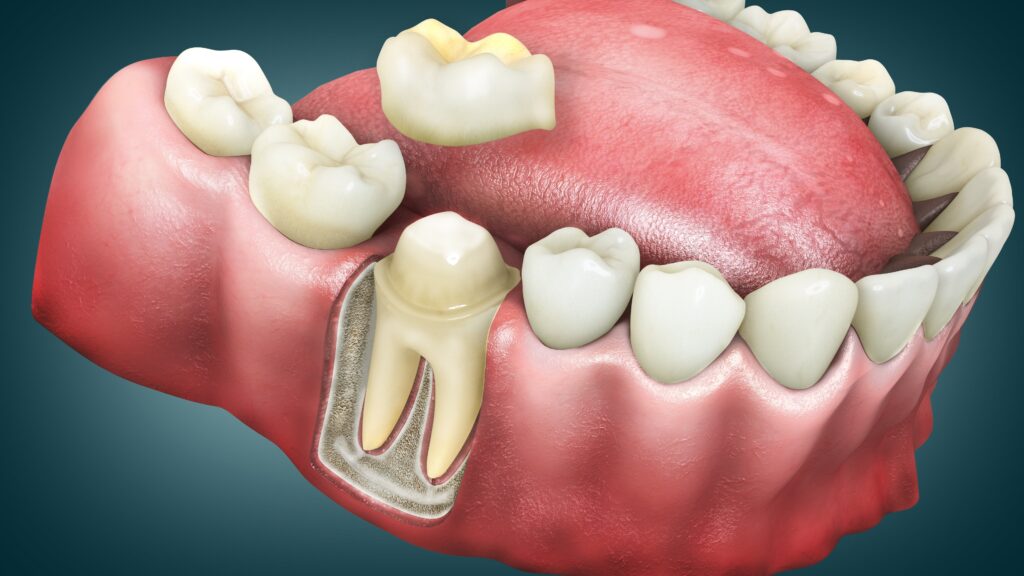 dental crowns disadvantages